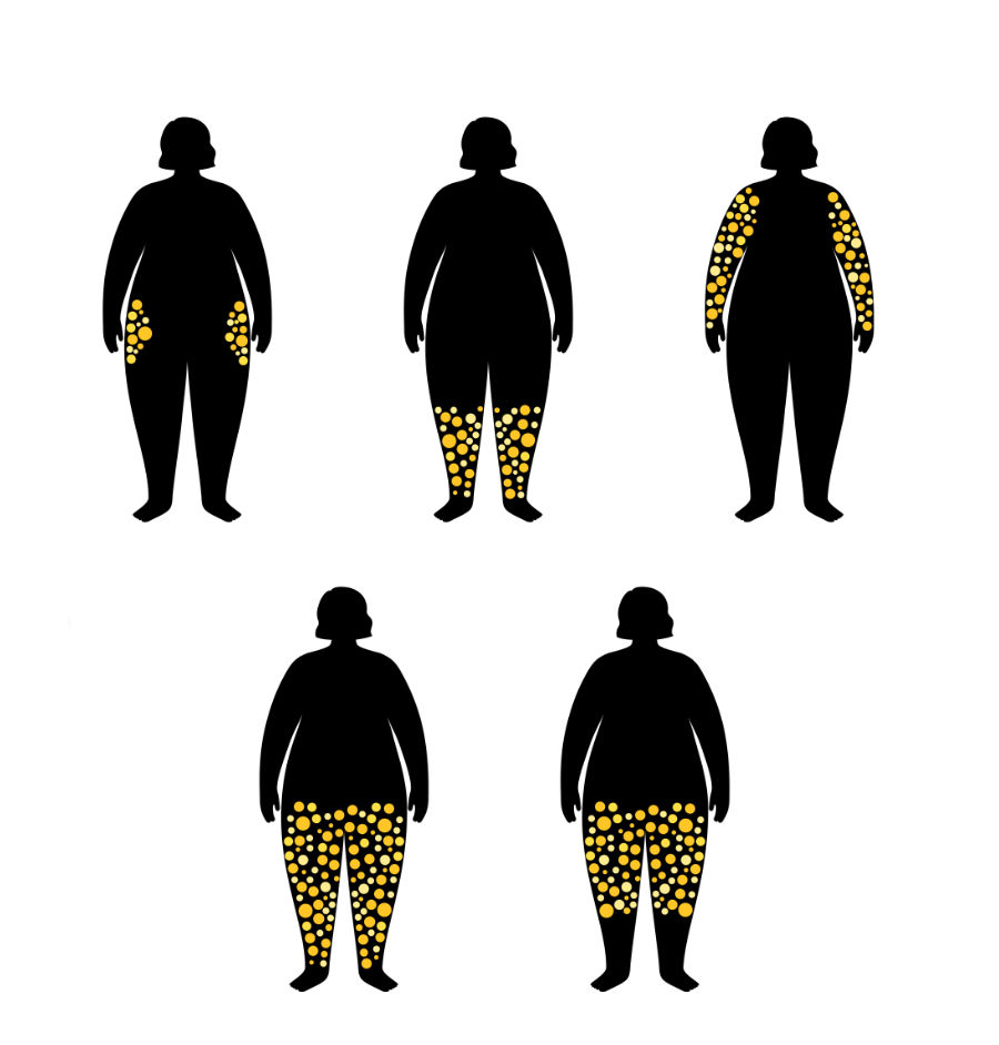 BoxBar Beauty | Lipedema